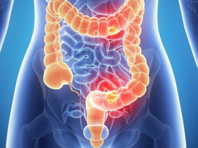 COLONOSCOPIE la CARANSEBES                                               Dr Aljobory&nbsp;Clinic